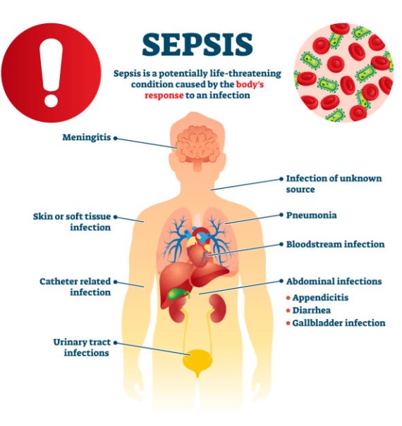 🧓 Sepsis in Senior Citizens: Awareness and Prevention
