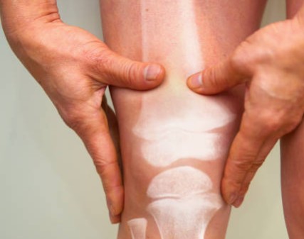 Arthritis in Elders: Understanding and Managing the Condition